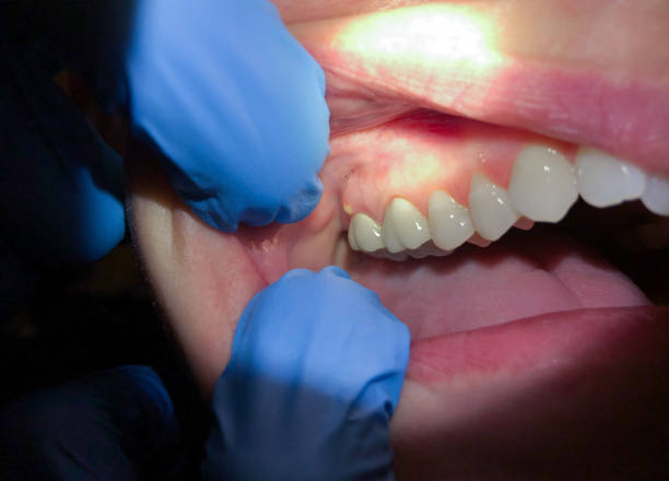 Best Knocked-Out Tooth (Avulsed Tooth) Treatment in Langley Park, MD